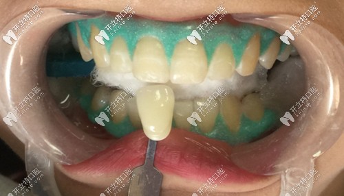 藝星口腔的皓齒美白特色