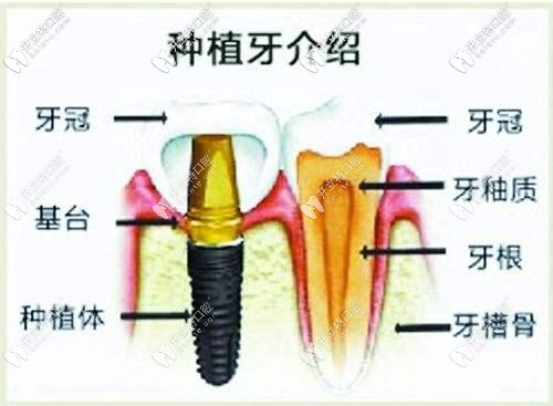 種植體和真牙的對比