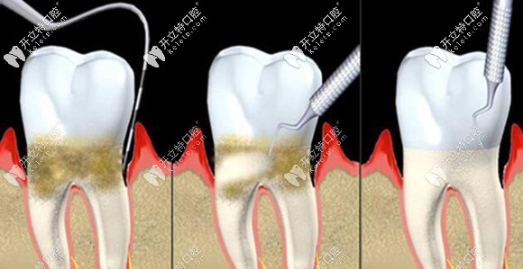 普通洗牙和深度洗牙的區(qū)別