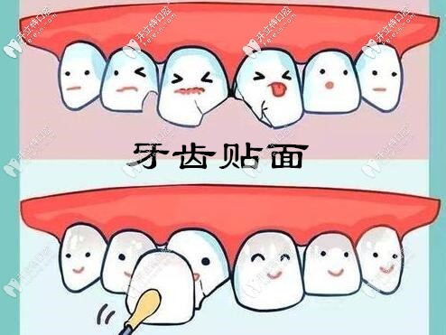 牙齒瓷貼面美白