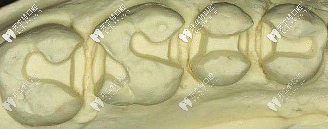 做嵌體需要有足夠的高度