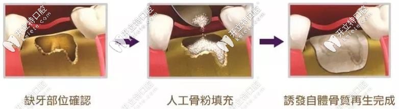 植骨粉種植牙過(guò)程