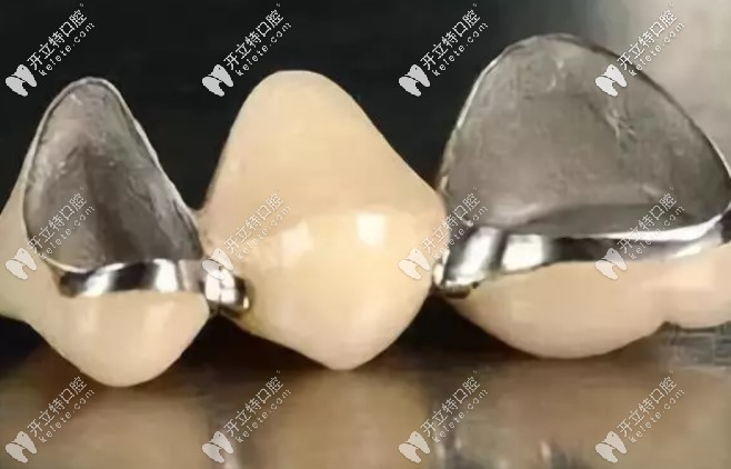 做了烤瓷牙我不想活了