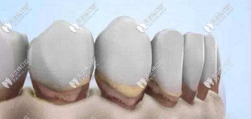 牙齦萎縮外觀示意圖