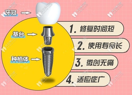 北京勁松美國皓齒種植牙