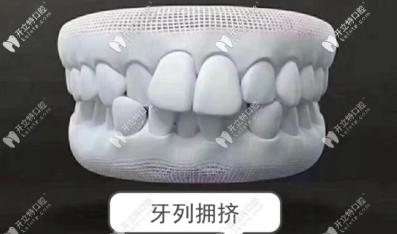 牙齒重疊擁擠排列不整齊也非正常咬合