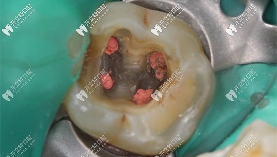 我的基牙已經(jīng)腐爛了只能做種植牙