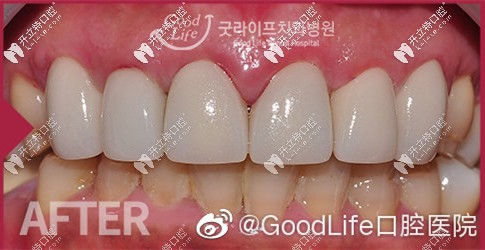 做完貼面后牙齒狀態(tài) 做完貼面后牙齒狀態(tài)