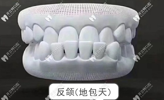 反頜牙也叫做地包天