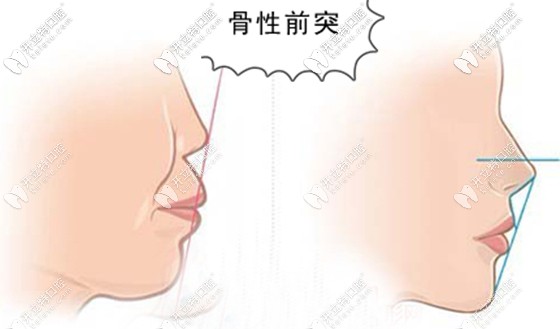 良心醫(yī)生不建議盲目做正頜