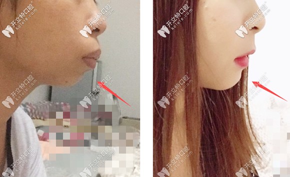 成功的正畸正頜聯(lián)合治療效果