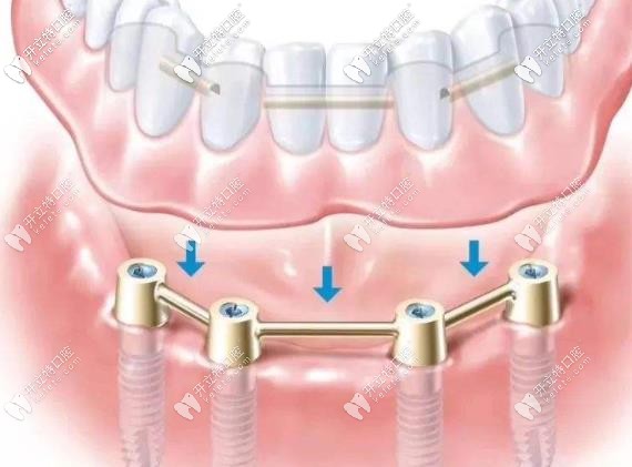 allon4種植體示意圖