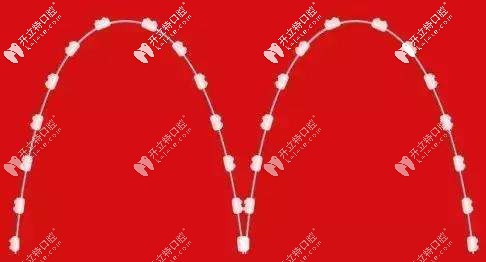 整牙時(shí)方弓絲和圓弓絲的區(qū)別