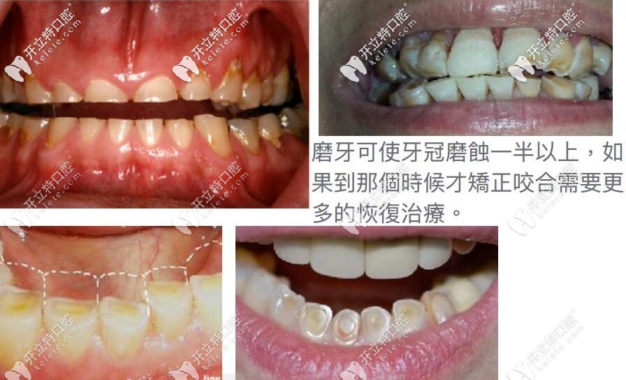 牙齒咬合不齊要及時矯正