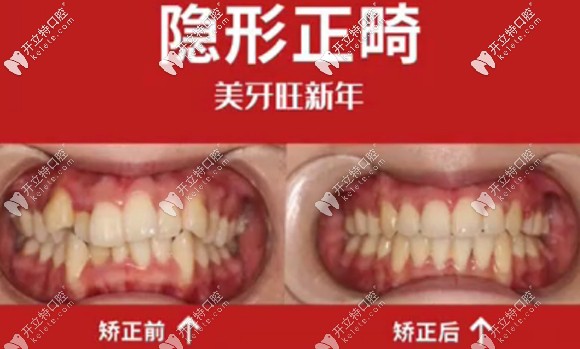 溫州潮媽的隱形矯正日記:戴隱適美牙套860天的收獲和感觸