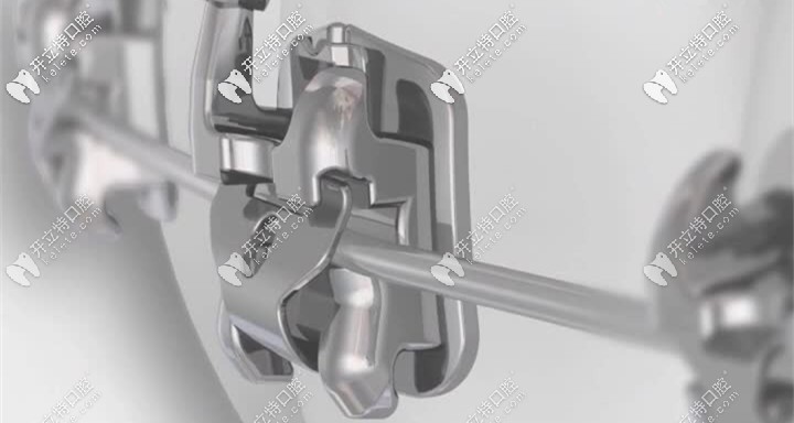 整牙時(shí)用到的自鎖托槽圓弓絲