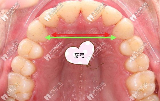 原來擴牙弓還分快速擴弓和慢速擴弓,而區(qū)別在于年齡的不同
