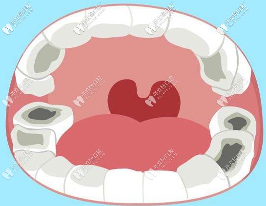 蛀牙和爛根殘冠容易咬到腮幫子