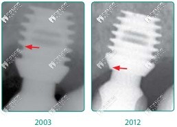 百康種植體不會出現(xiàn)骨吸收情況