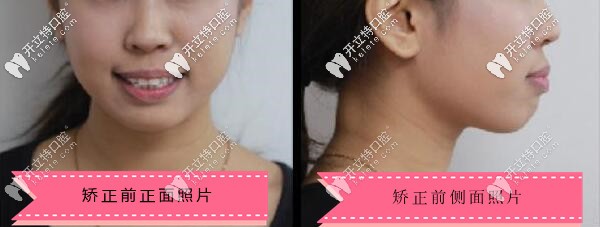 隱適美牙套解決了我的凸嘴,拿著齙牙矯正前后對比照得瑟下!