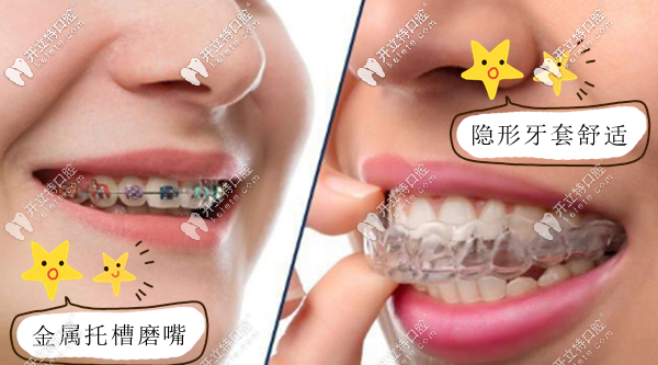 為了美觀舒適選擇做隱適美牙齒矯正