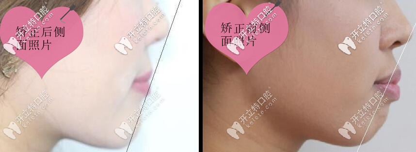 齙牙矯正前后側(cè)面對比照片