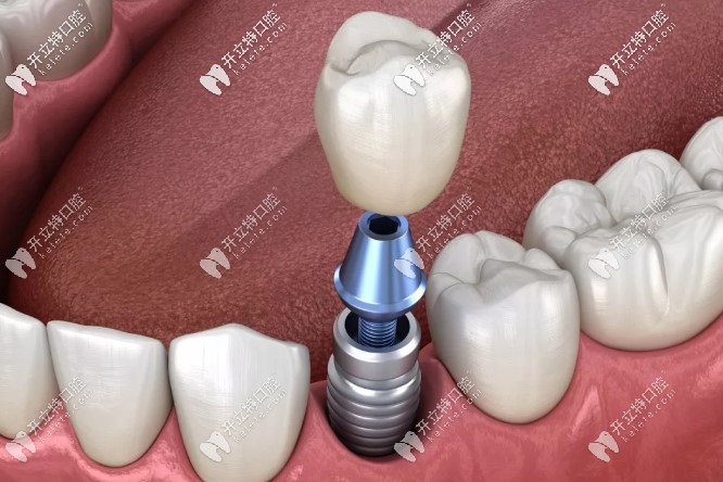 影響種植牙壽命的因素