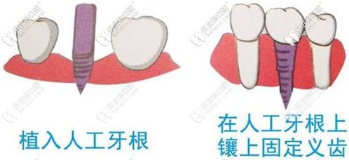 植入種植體后牙齒需要一定的時間愈合