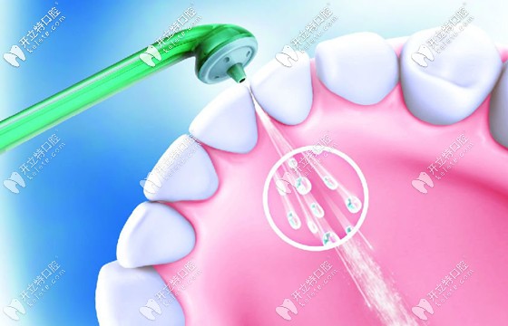 你做過(guò)洗牙保健嗎