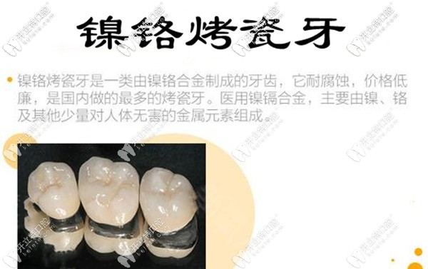 鎳鉻烤瓷牙價(jià)格