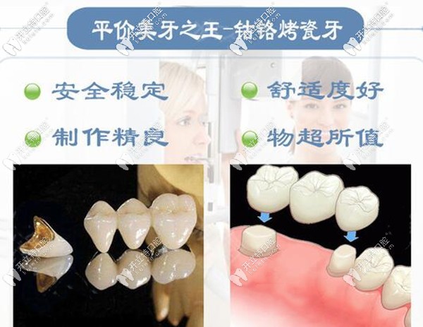 鈷鉻烤瓷牙優(yōu)勢(shì)