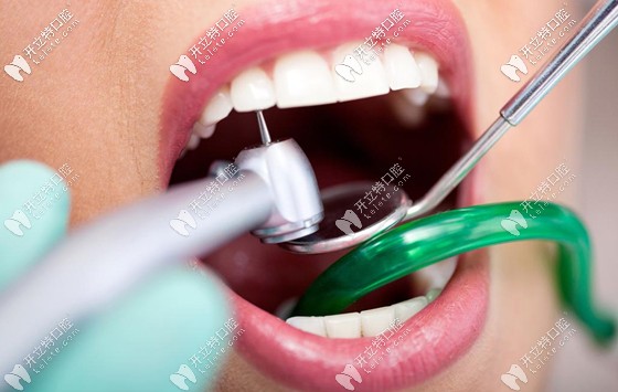 保護(hù)牙齒必須要做好口腔清潔衛(wèi)生，清除牙菌斑是關(guān)鍵