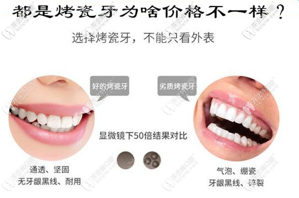 這份重慶烤瓷牙的種類及價格表,帶你避開鑲牙的套路