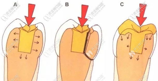 看完emax鑄瓷嵌體的特點(diǎn)，可算知道它的價格咋來的了