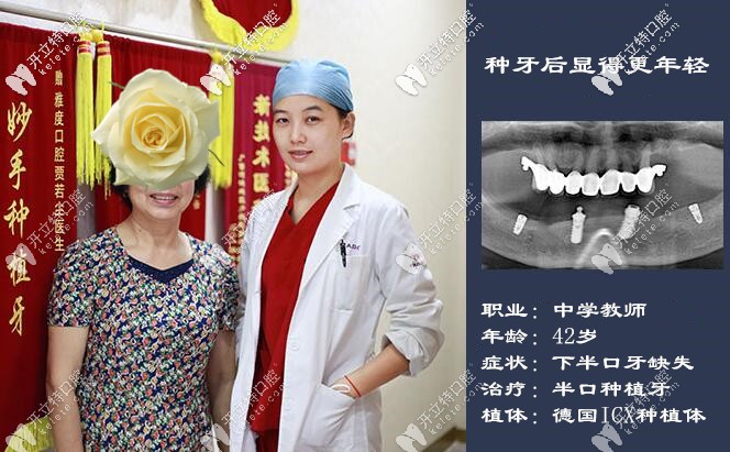 這次在廣州做的德國ICX半口種植牙挺滿意的,價格也美