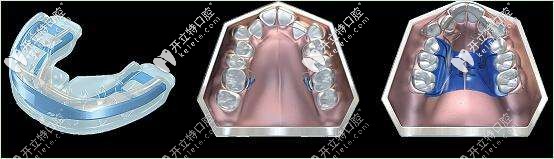 MRC肌功能矯治器