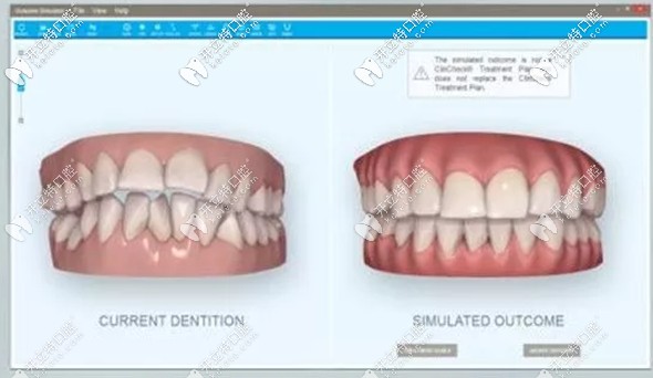 采用隱形矯正術(shù)前就可預(yù)見矯正效果