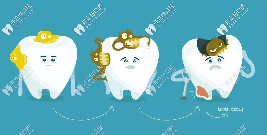 別不信,兒童牙齒齲壞到重度就要做根管治療啦！