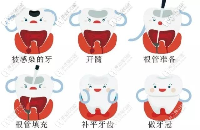 根管治療過(guò)程