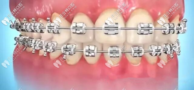 剛戴牙套牙齒樣子