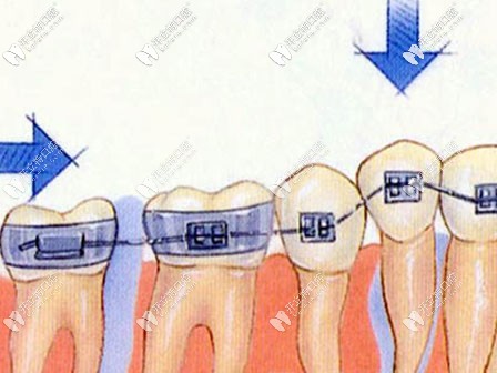 牙齒正畸的過(guò)程示意圖 牙齒正畸的過(guò)程示意圖