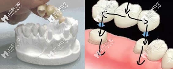 全瓷牙和烤瓷牙冠修復(fù)牙齒缺失