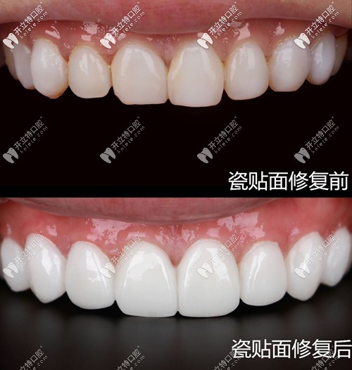 瓷貼面修復(fù)前后對(duì)比圖