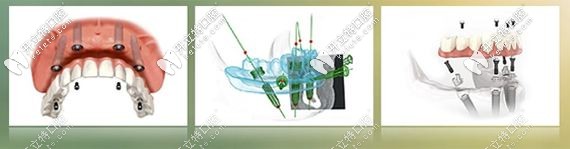 All-on-4全口種植牙解析圖