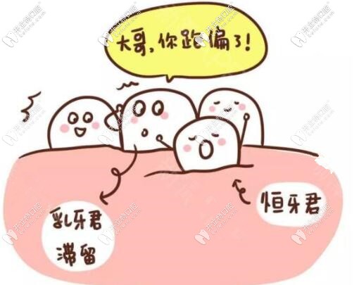 注意!奶牙未掉恒牙長出的乳牙滯留必須拔除,否則危害多多