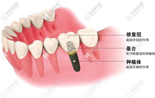 別迷糊,種植牙的原裝成品基臺和個性化定制基臺區(qū)別在這