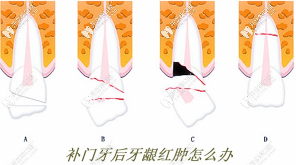 補牙后牙齦紅腫的原因