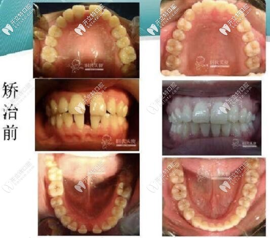 北京勁松口腔時代天使牙套案例