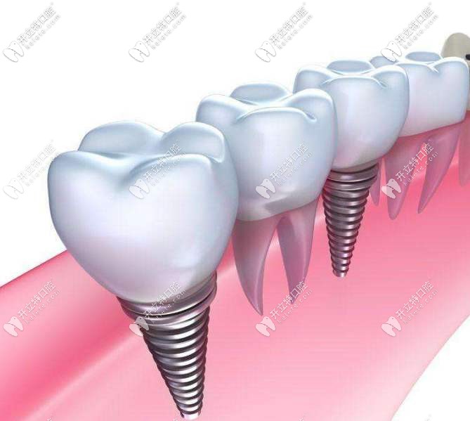 種植牙外觀示意圖