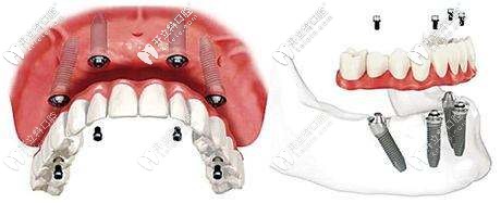 即刻負重種植牙